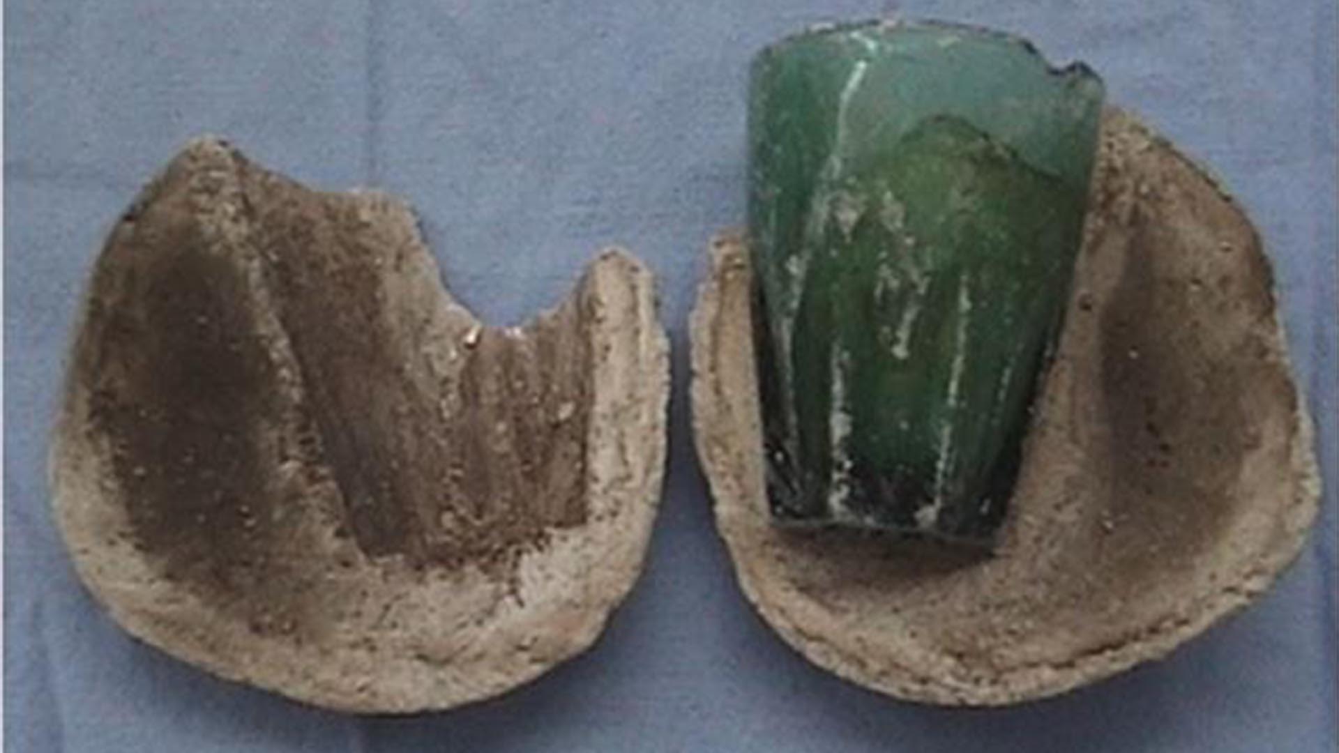Karın ağrısı şikâyetiyle hastaneye giden kadının cinsel organından 8 cm uzunluğunda bardak çıktı