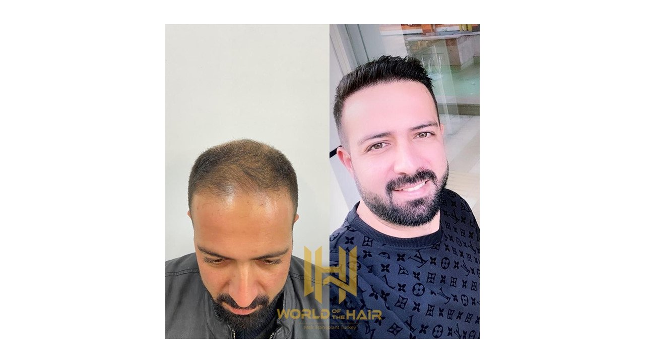 Saç Ekimi Yöntemleri – World of the Hair