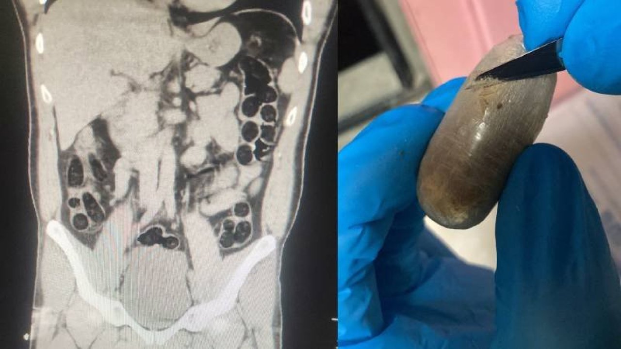 İranlı yolcunun midesinden 714 gram eroin çıktı