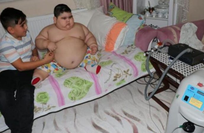 4 yaşında 70 kiloya ulaştı... ‘Solunum cihazı olmadan uyuyamıyor’
