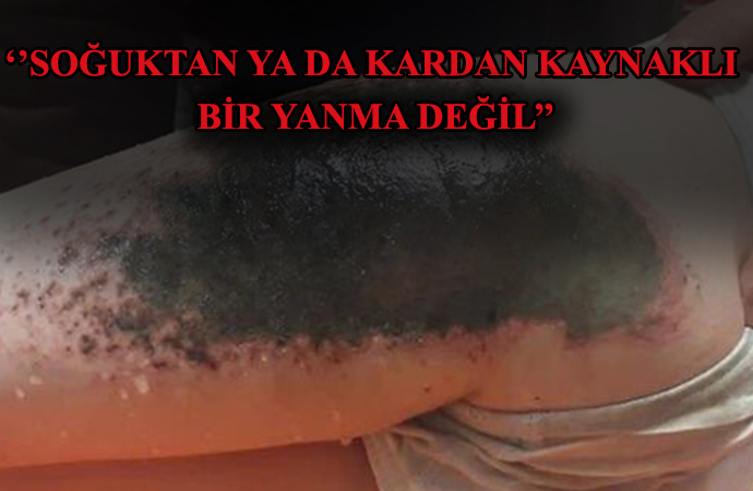 Kar topu oynarken vücutlarında yanık oluşmuştu! Uzmanlardan açıklama: ‘Kimyasal yanmaya işaret ediyor’