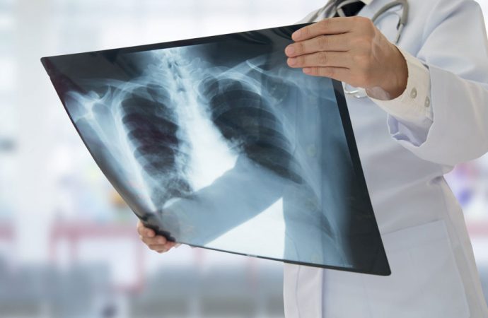 Buzlu cam benzeri yapılar… İyileşen korona hastalarının akciğerlerinde şoke eden bulgular