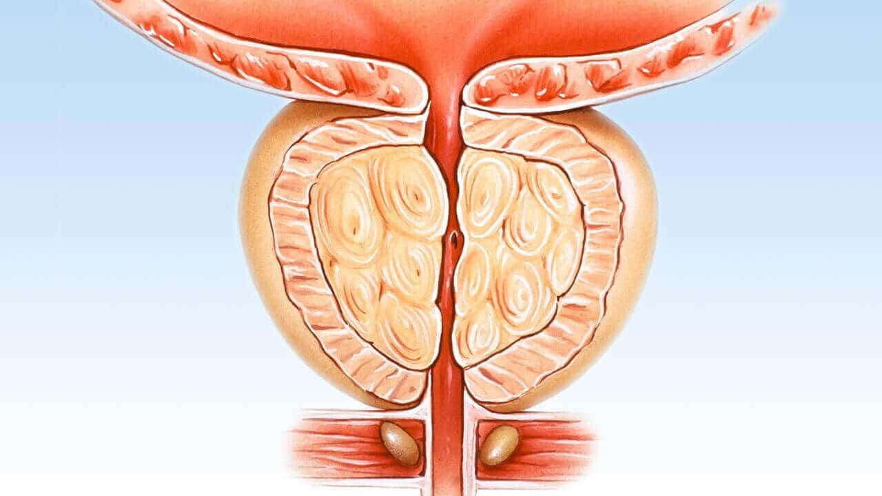 Prostat biyopsisi
