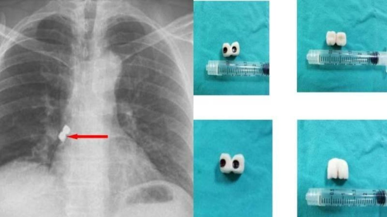 Afyonkarahisar'da, bir kişinin soluk borusuna diş tedavisi sırasında 2 implant kaçtı