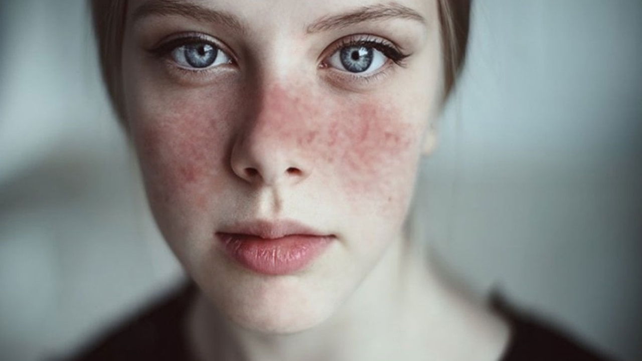 Lupus Nedir: Belirtileri, Nedenleri ve Tedavi Yöntemleri