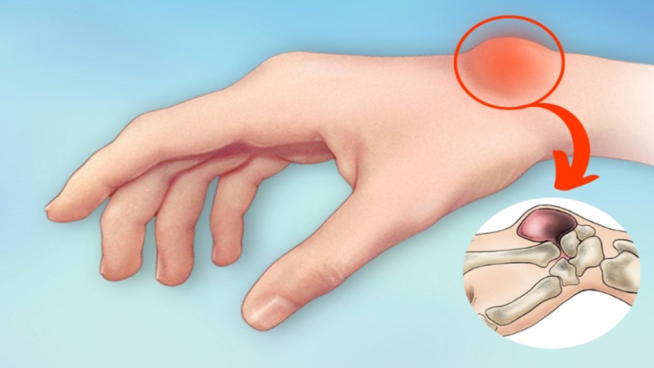 Ganglion Kisti: Belirtileri, Tedavisi ve Daha Fazlası