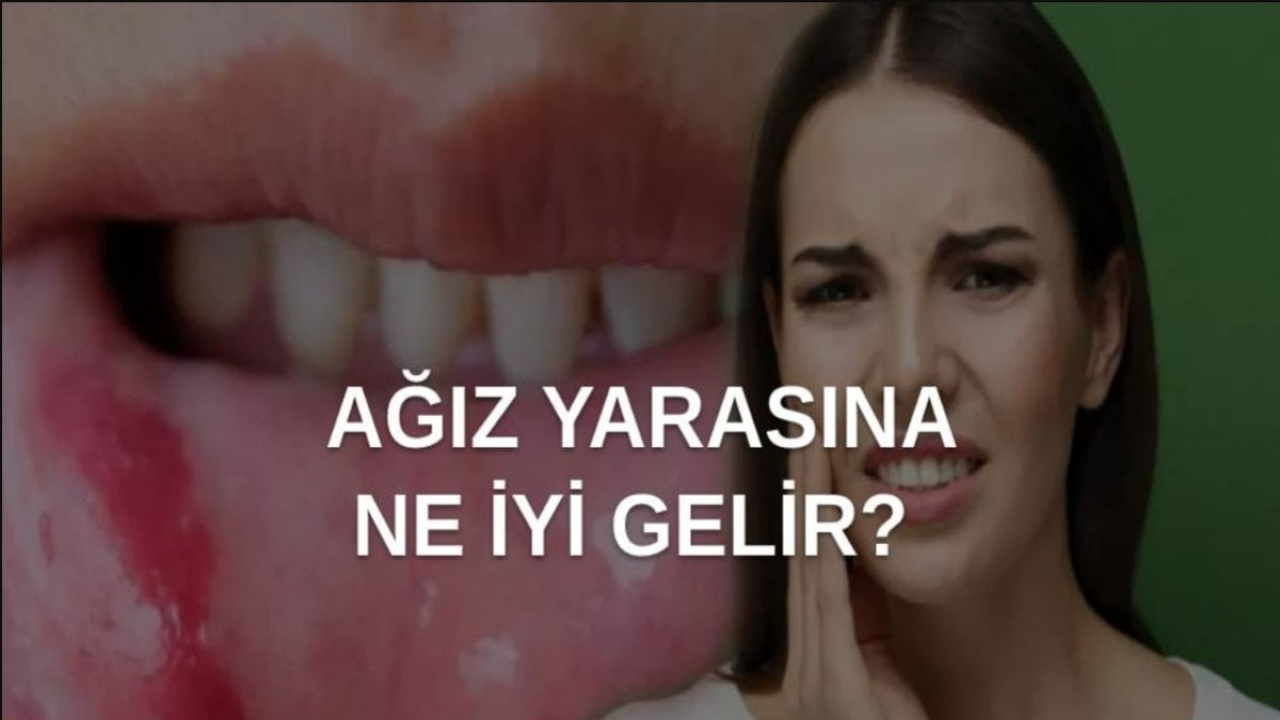 Ağız İçi Yaralarına Ne İyi Gelir: Rahatlatıcı ve Doğal Çözümler