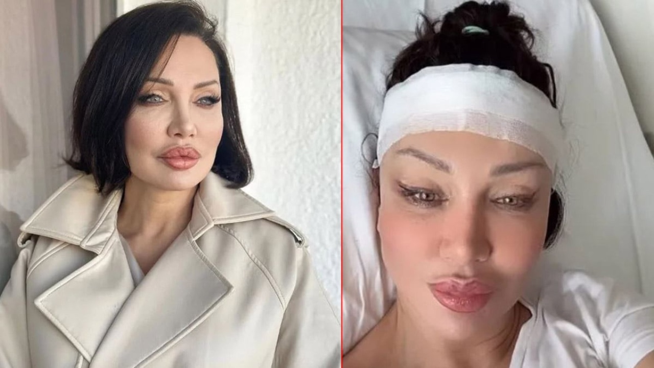 Yerli Angelina Jolie, alın daraltma ameliyatı oldu! Son hali sosyal medyanın diline düştü :