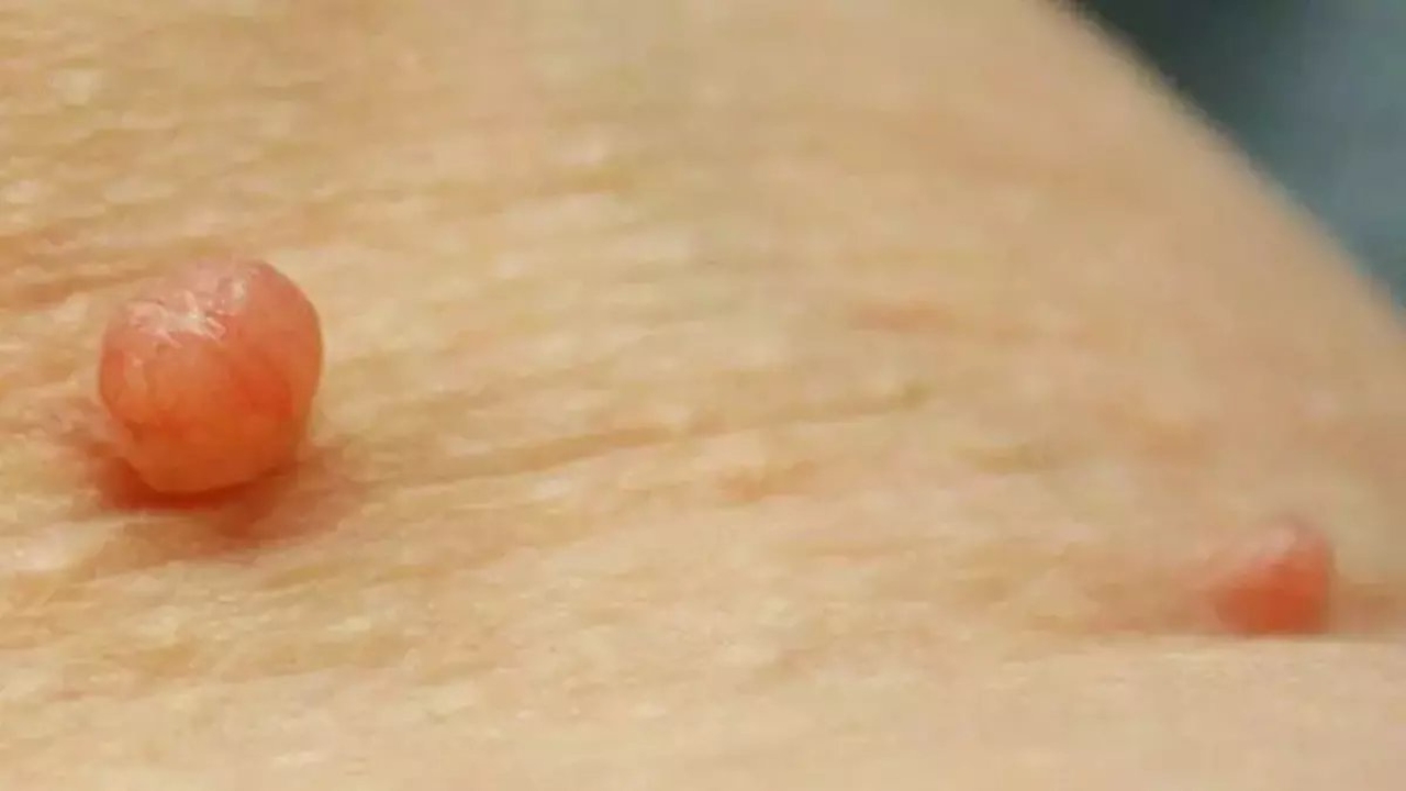 Et benlerini ameliyat gerektirmeden kolayca düşürecek yöntem bulunmuş oldu! Bu doğal yöntemle çok kolay: Evdek