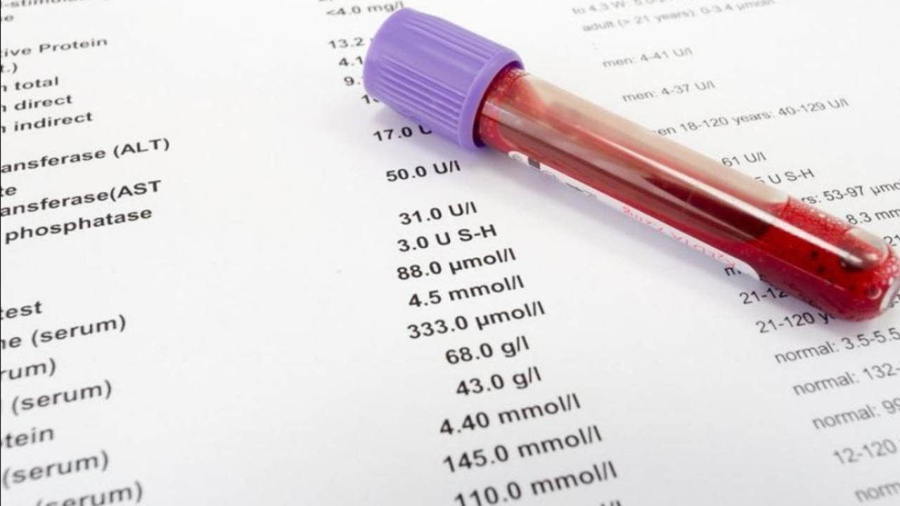 Bilirubin Total Nedir: Karaciğer Fonksiyonları ve Sağlık İçin Önemi