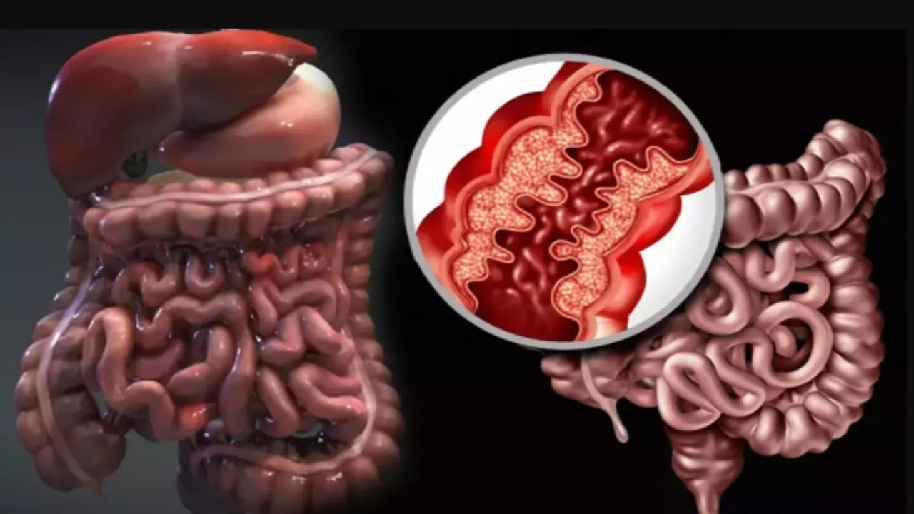 Crohn Hastalığı Nedir?