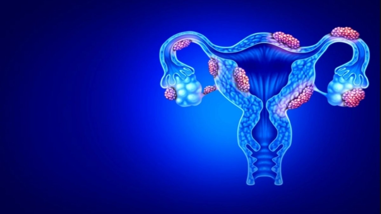 Çikolata Kisti Nedir: Belirtileri, Nedenleri ve Tedavisi