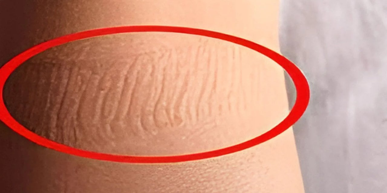 Çorap sıkı olmasa bile ayağınızda oluşan bu izler masum değil!