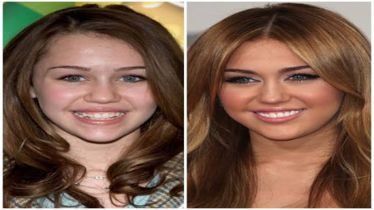 Hollywood Smile Modası!
