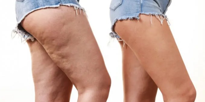Selülit nedir? Nasıl oluşur?