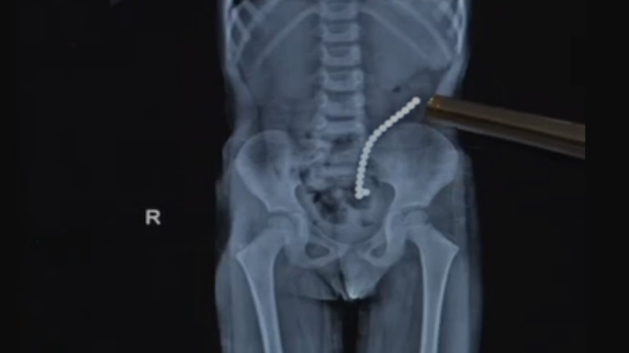 Karın ağrısı şikayetiyle doktora götürülen çocuğun bağırsağından çıkanlar şoke etti