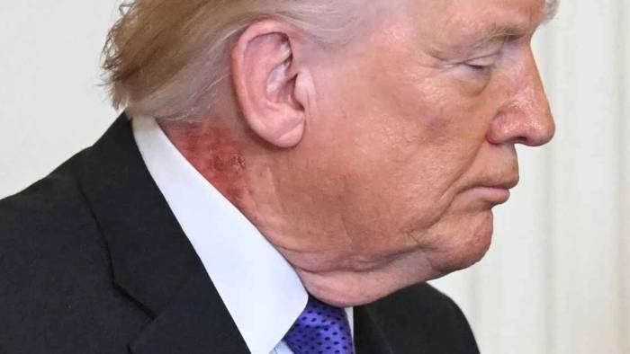 Trump’ın boynundaki kızarıklığın sebebini doktoru açıkladı